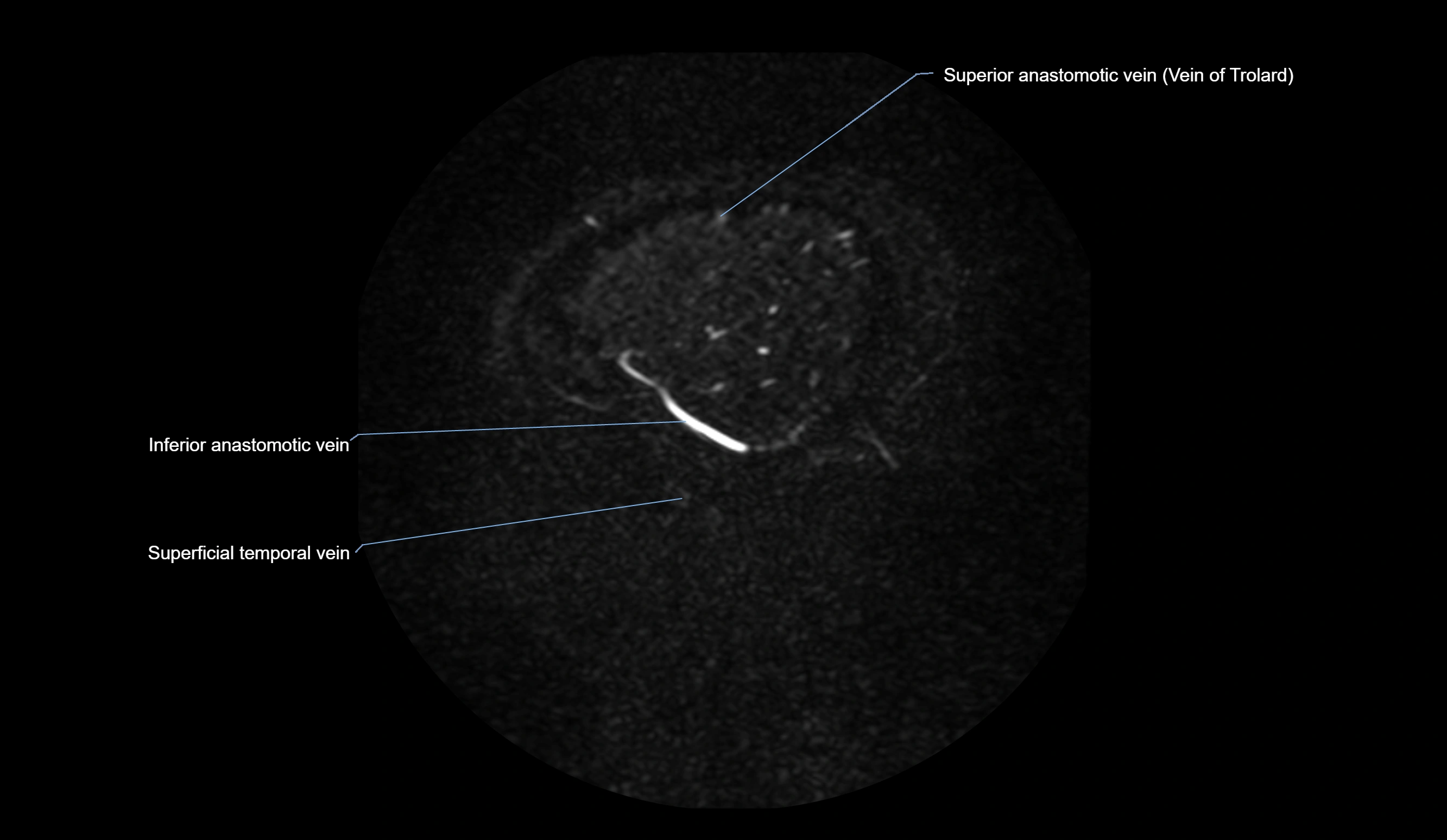 MRV brain sagittal anatomy 3T MRI images -img-01015-00072.webp